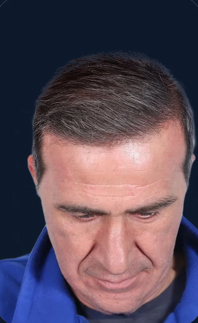 Vaka 1, üstten görünüm (baş öne eğik), ön ve orta bölge: işlem sonrası