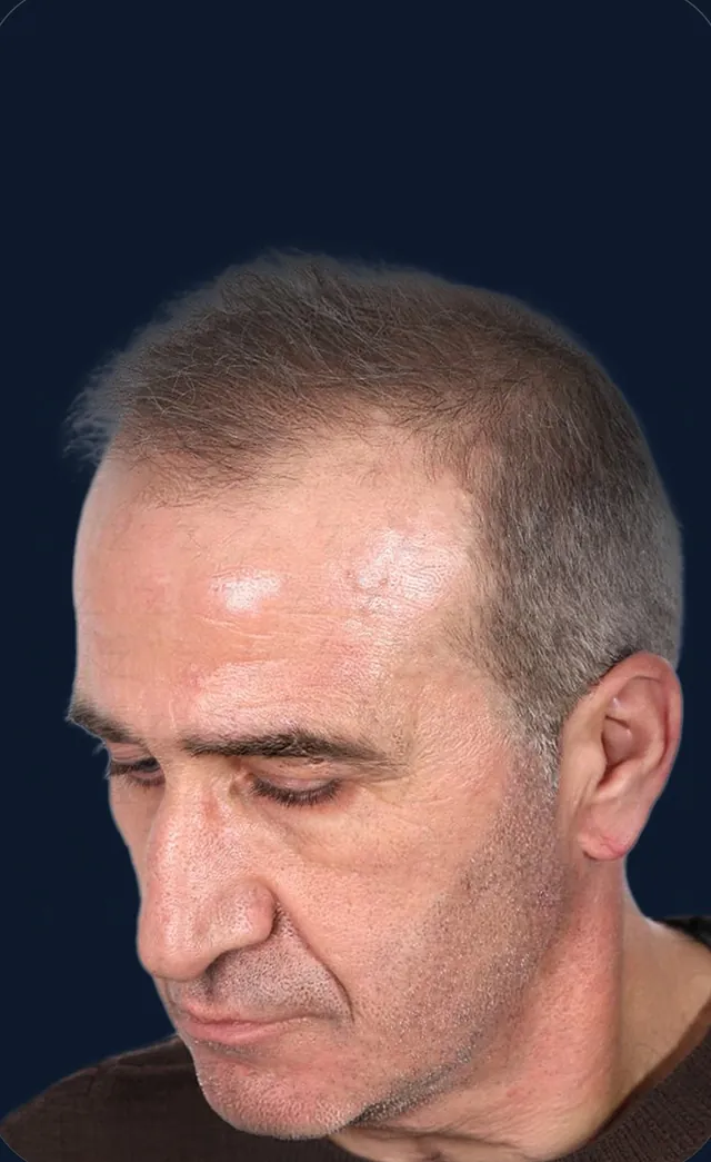 Vaka 1, yarı yandan görünüm, ön çizgi ve şakak: işlem öncesi