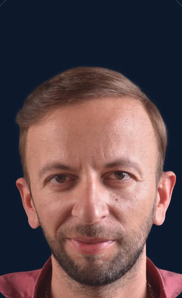Vaka 2, önden görünüm, ön saç çizgisi ve alın bölgesi: işlem sonrası