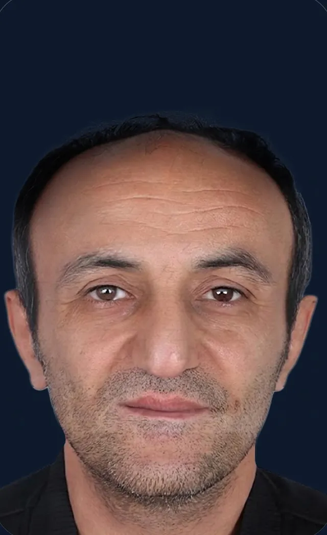 Vaka 4, önden görünüm, ön saç çizgisi ve alın bölgesi: işlem öncesi