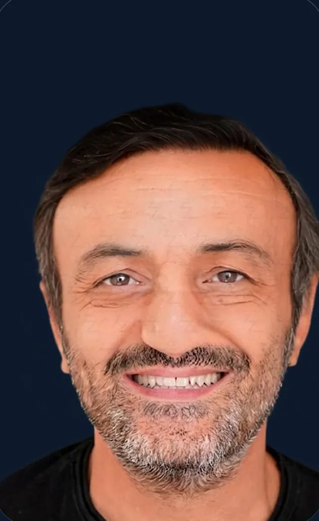 Vaka 4, önden görünüm, ön saç çizgisi ve alın bölgesi: işlem sonrası