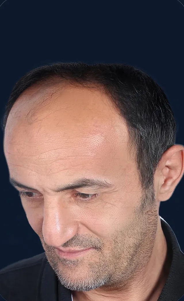 Vaka 4, üstten görünüm (baş öne eğik), ön ve orta bölge: işlem öncesi