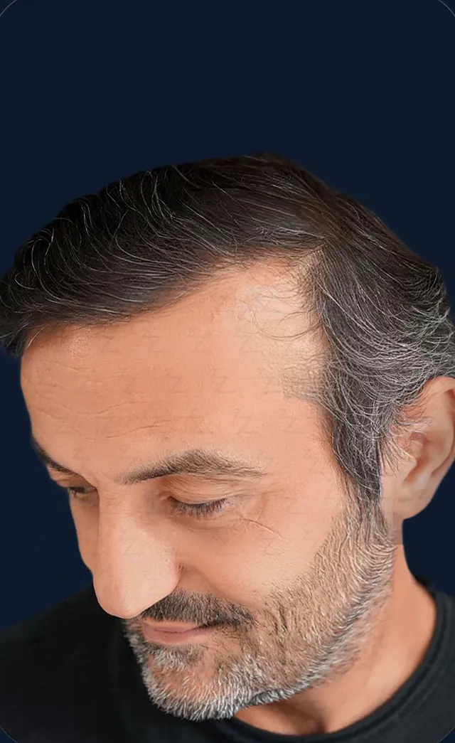 Vaka 4, üstten görünüm (baş öne eğik), ön ve orta bölge: işlem sonrası