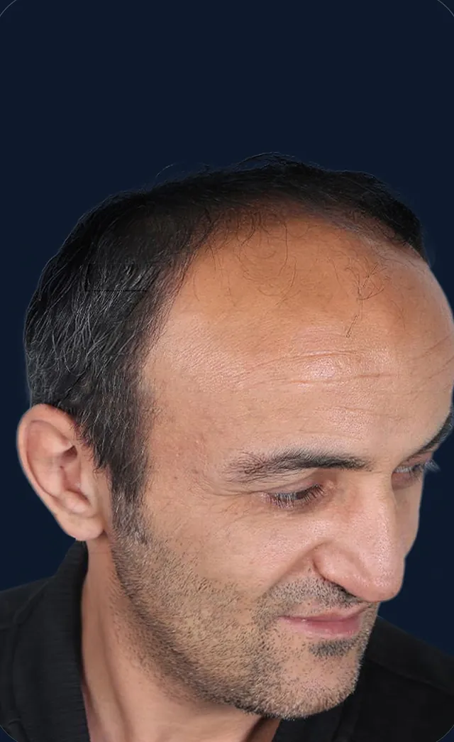 Vaka 4, yarı yandan görünüm, ön çizgi ve şakak: işlem öncesi
