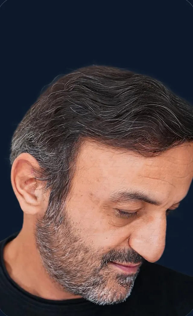 Vaka 4, yarı yandan görünüm, ön çizgi ve şakak: işlem sonrası