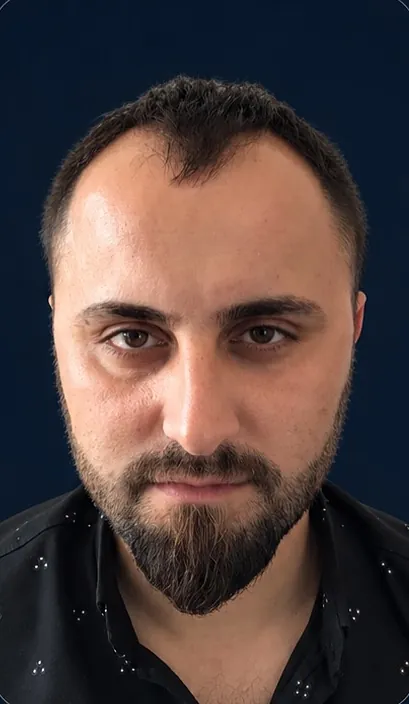 Vaka 5, önden görünüm, ön saç çizgisi ve alın bölgesi: işlem öncesi