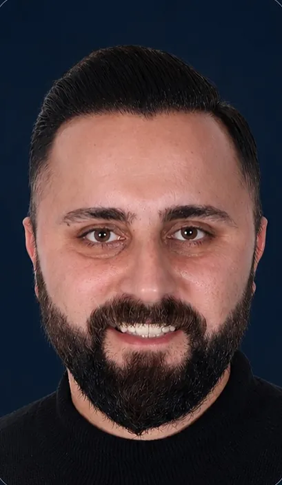 Vaka 5, önden görünüm, ön saç çizgisi ve alın bölgesi: işlem sonrası