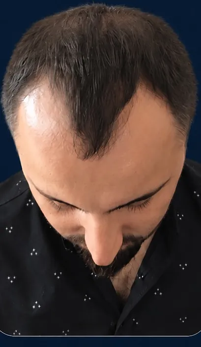 Vaka 5, üstten görünüm (baş öne eğik), ön ve orta bölge: işlem öncesi
