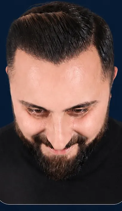 Vaka 5, üstten görünüm (baş öne eğik), ön ve orta bölge: işlem sonrası