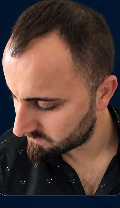 Vaka 5, yarı yandan görünüm, ön çizgi ve şakak: işlem öncesi