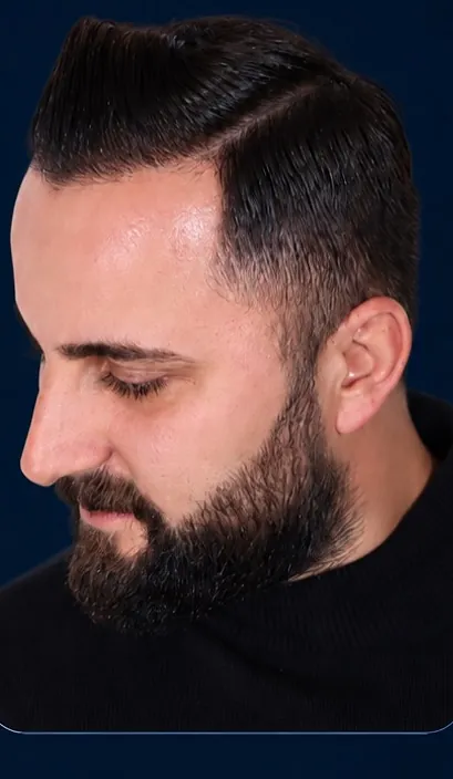 Vaka 5, yarı yandan görünüm, ön çizgi ve şakak: işlem sonrası